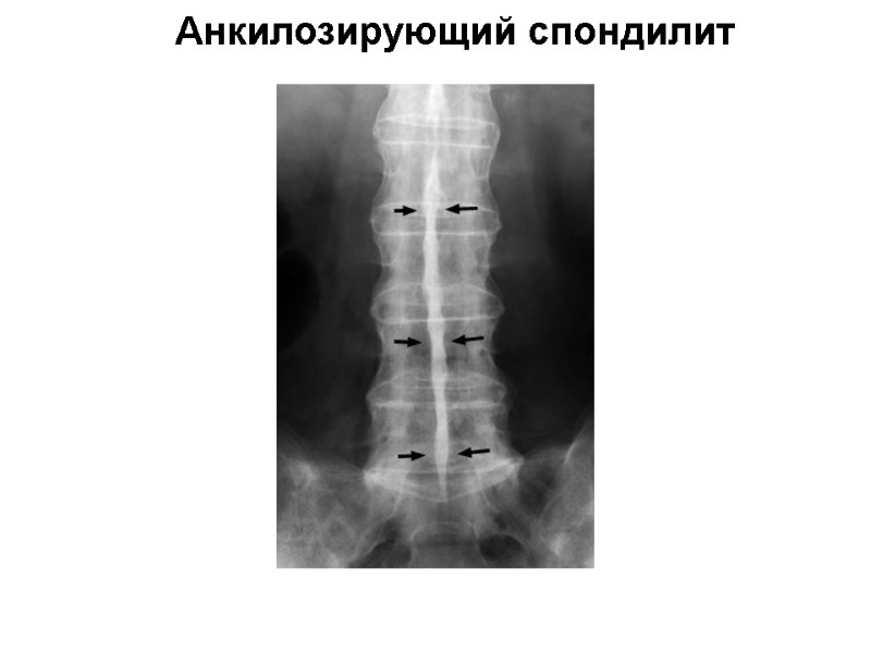 Анкилозирующий спондилит